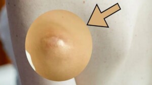 Lumps of fat forming on the back: what are those exactly?