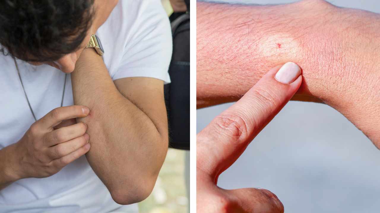 a man found a blister on the arm