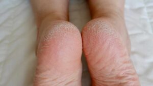Cracked Heels: the Remedies That Really Work