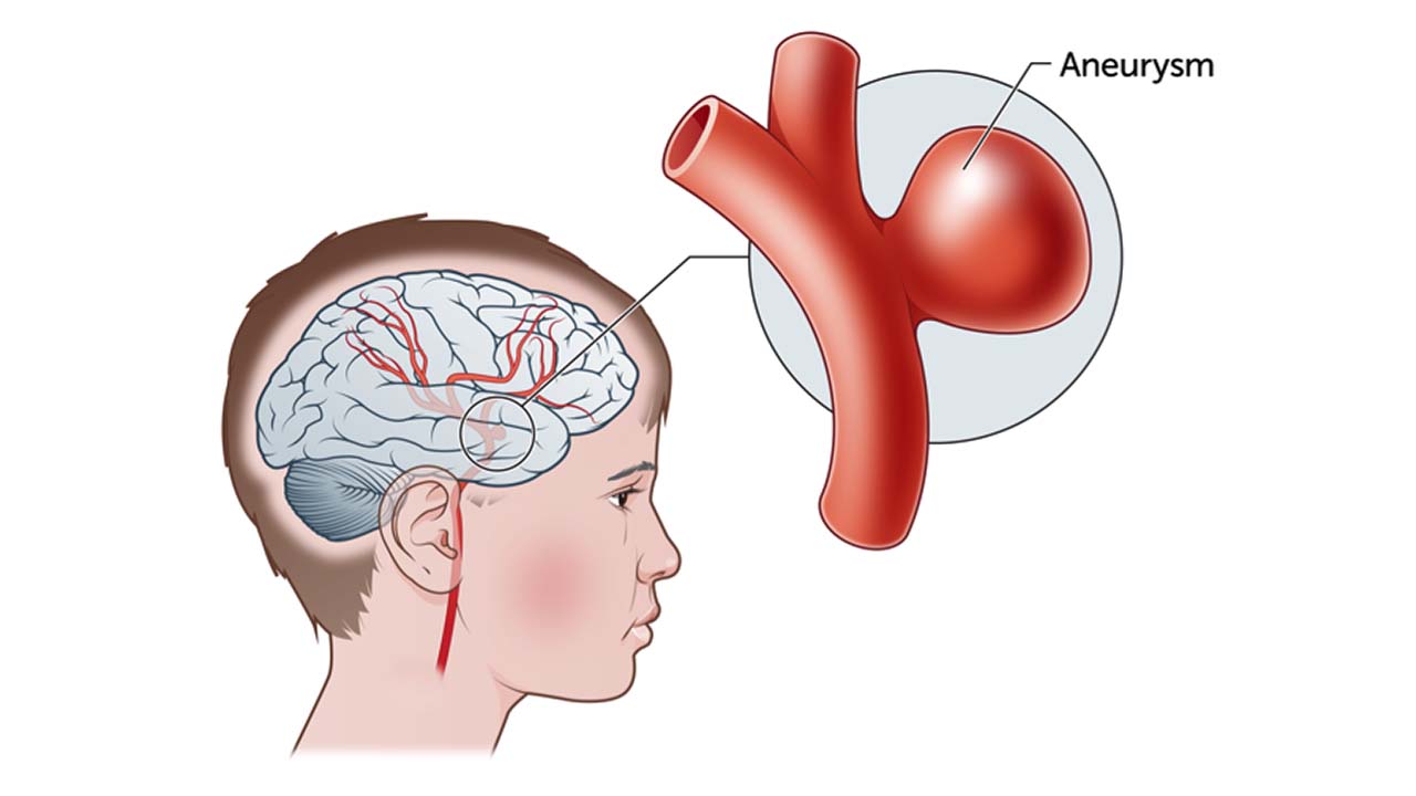 We know the symptoms of an aneurysm, a problem that, if left untreated can be fatal