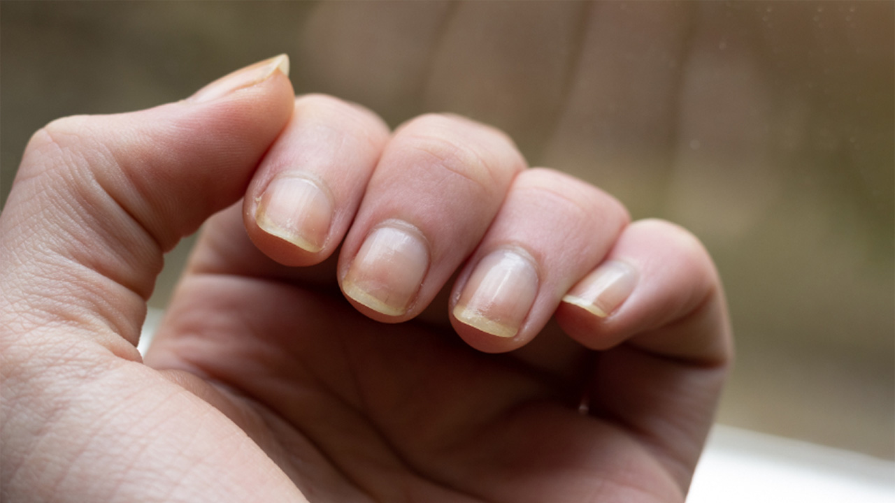 The effective and natural remedy for whitening yellowed nails